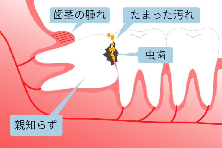 親知らずは抜く?抜かない?